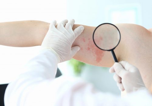 A Dermatite Atópica Demanda Cuidado Multidiciplinar