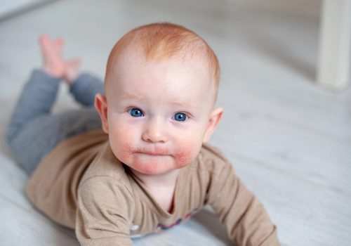 Como o microbioma interfere na dermatite atópica